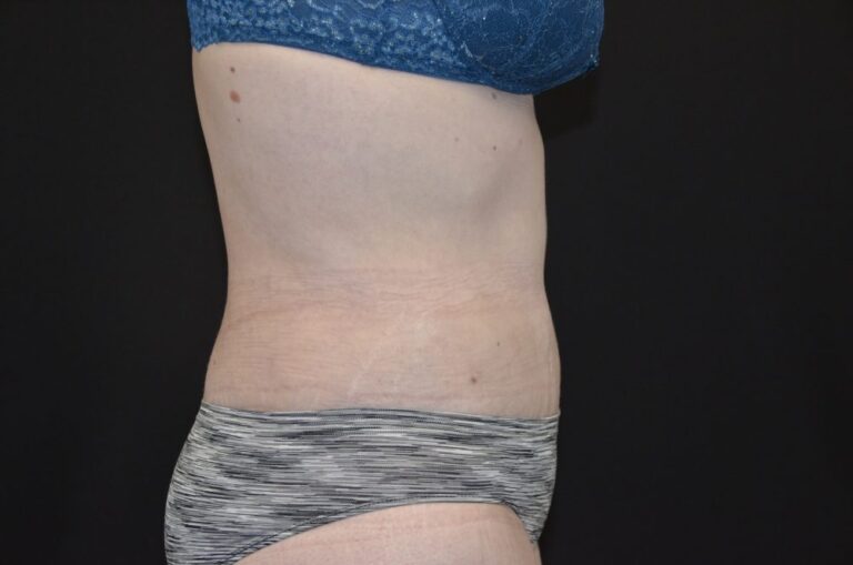 After Image: Tummy Tuck - right-side