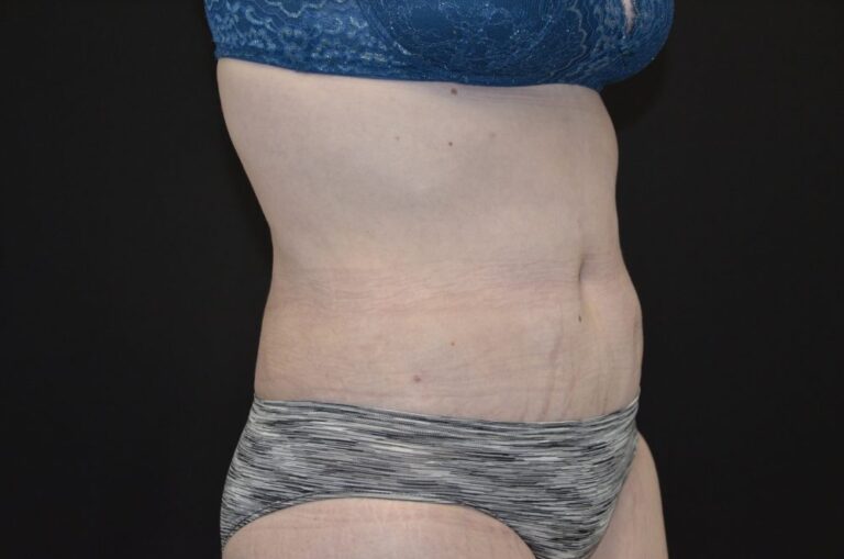 After Image: Tummy Tuck - right-front-oblique