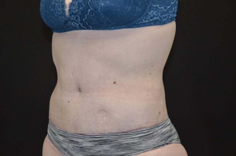 After Image: Tummy Tuck - left-front-oblique