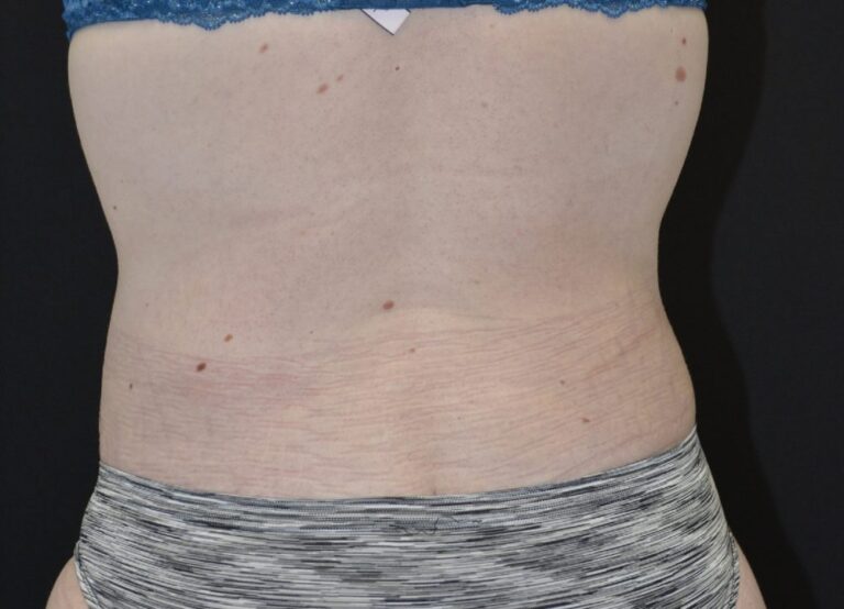 After Image: Tummy Tuck - back