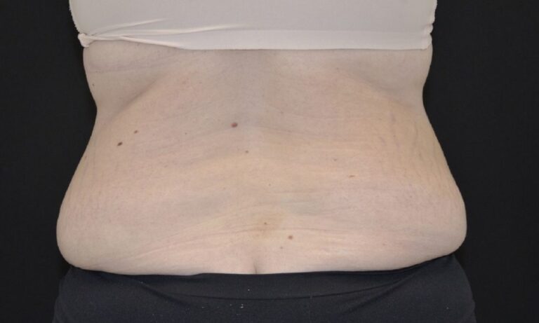 Before Image: Tummy Tuck - back