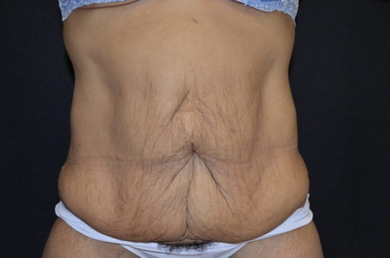 Before Image: Tummy Tuck - front