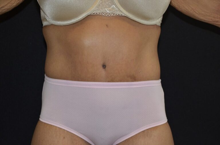 After Image: Tummy Tuck - front