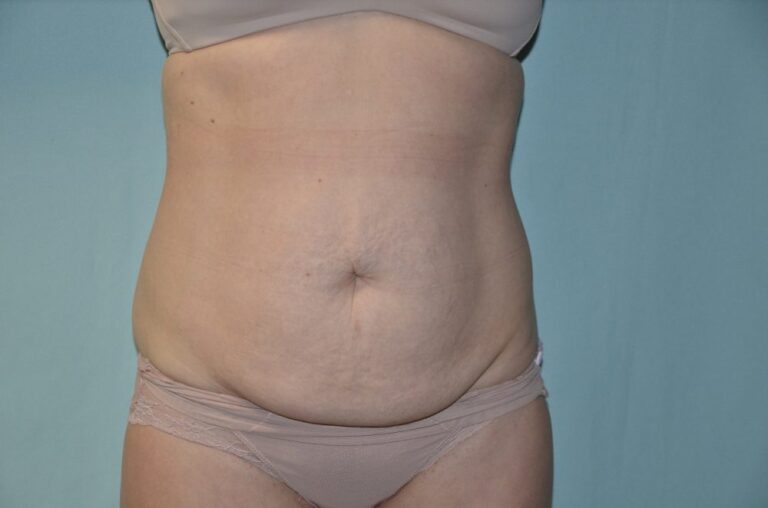 Before Image: Tummy Tuck - front