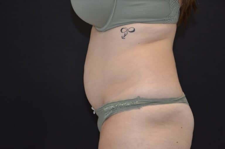 Before Image: Tummy Tuck - left-side