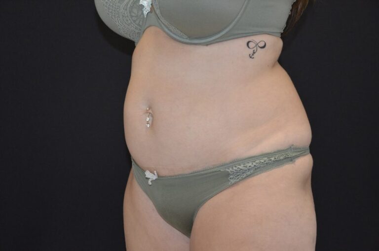 Before Image: Tummy Tuck - left-front-oblique