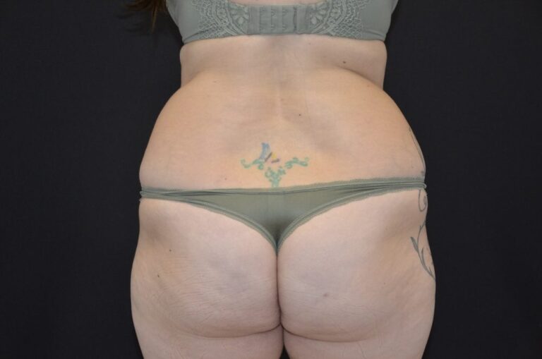 Before Image: Tummy Tuck - back