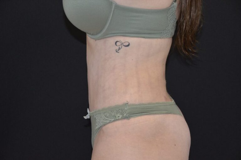 After Image: Tummy Tuck - left-side