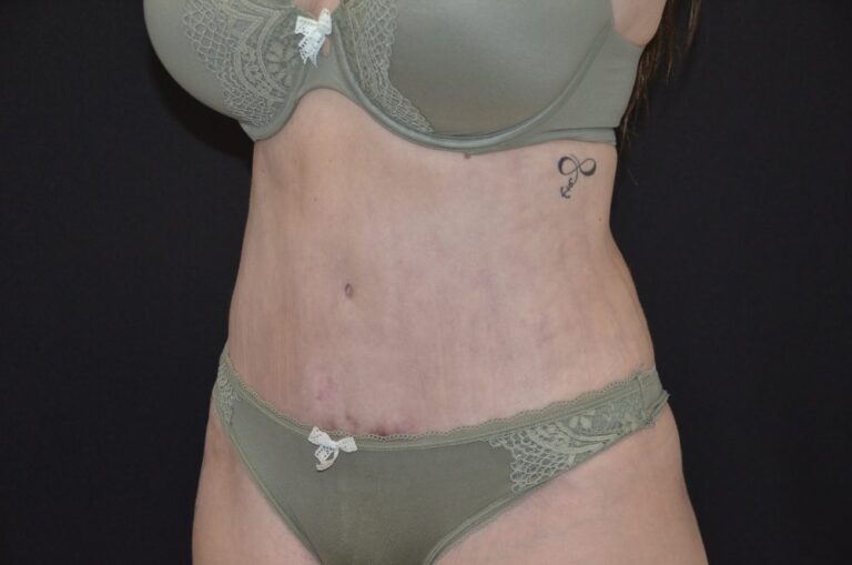 After Image: Tummy Tuck - left-front-oblique