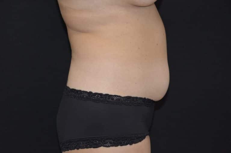 Before Image: Tummy Tuck -