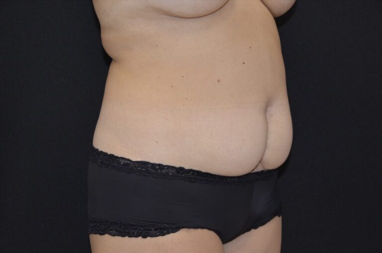 Before Image: Tummy Tuck - right-front-oblique