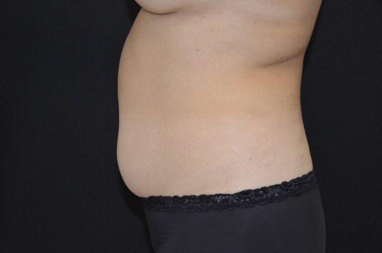 Before Image: Tummy Tuck - left-side