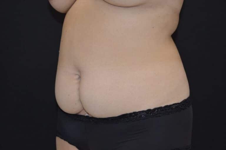 Before Image: Tummy Tuck - left-front-oblique