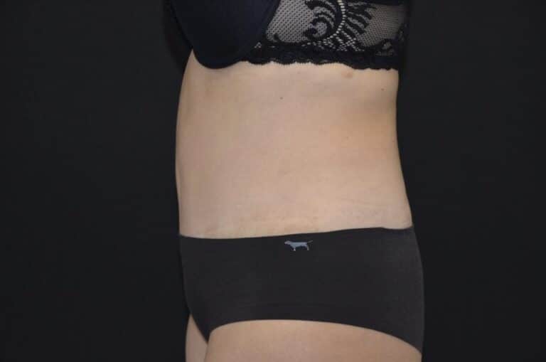 After Image: Tummy Tuck - left-side