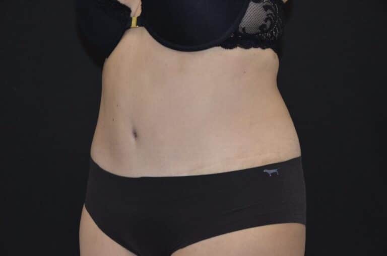 After Image: Tummy Tuck - left-front-oblique