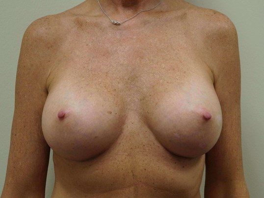 After Image: Breast Augmentation, Breast Procedure - front