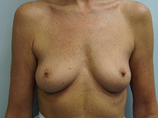 Before Image: Breast Augmentation, Breast Procedure - front