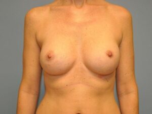 After Image: Breast Augmentation, Breast Procedure