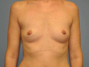 Before Image: Breast Augmentation, Breast Procedure