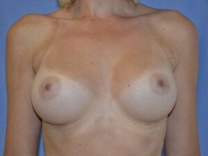 After Image: Breast Augmentation, Breast Procedure