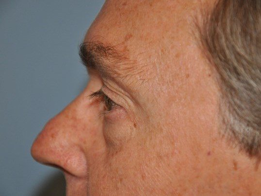 Before Image: Lower Blepharoplasty - left-side