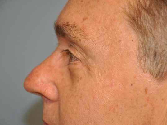 After Image: Lower Blepharoplasty - left-side