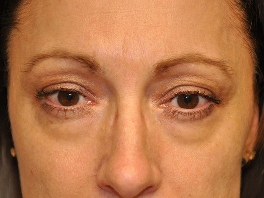 Before Image: Lower Blepharoplasty/Upper Blepharoplasty - front