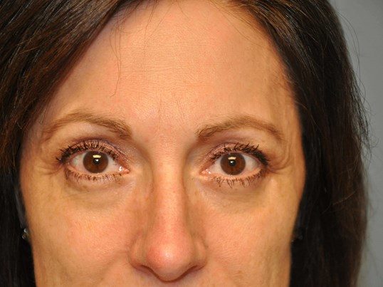 After Image: Lower Blepharoplasty/Upper Blepharoplasty - front