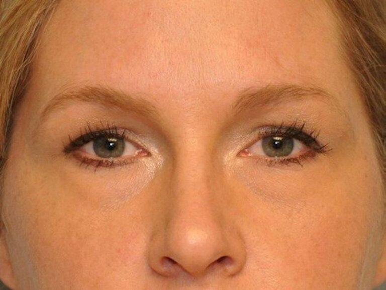 Before Image: Lower Blepharoplasty/Upper Blepharoplasty - front