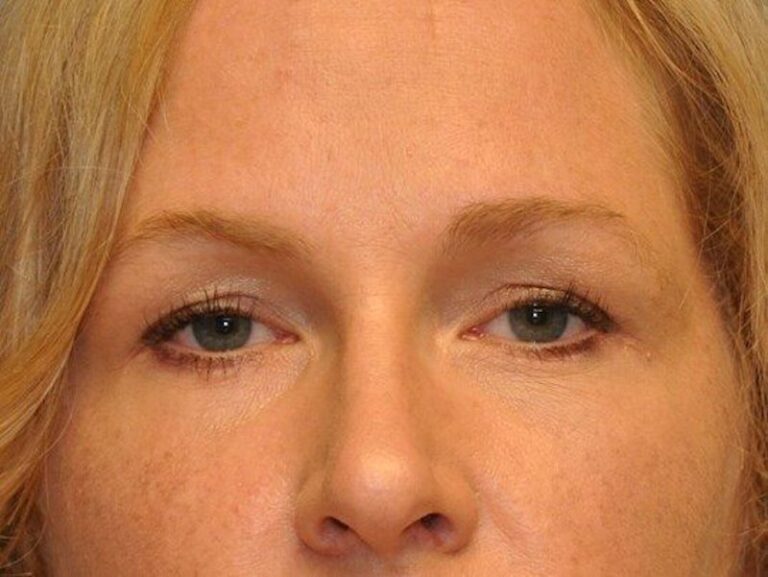 After Image: Lower Blepharoplasty/Upper Blepharoplasty - front