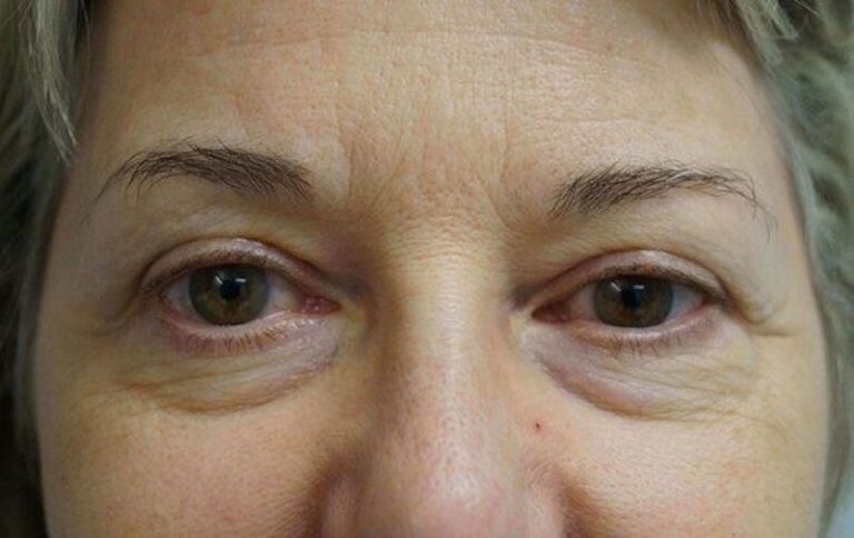 Before Image: Lower Blepharoplasty - front