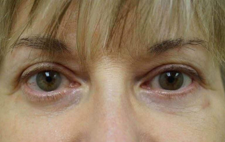 After Image: Lower Blepharoplasty - front