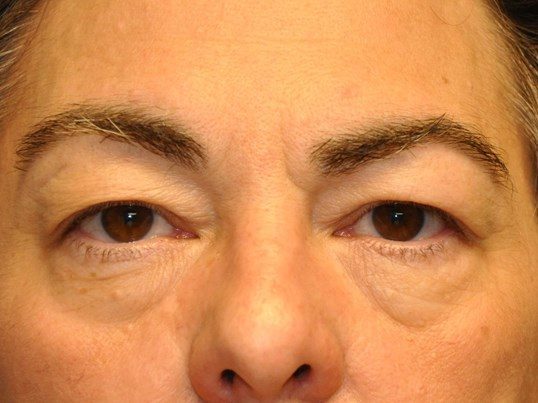 Before Image: Lower Blepharoplasty/Upper Blepharoplasty - front