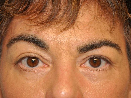 After Image: Lower Blepharoplasty/Upper Blepharoplasty - front