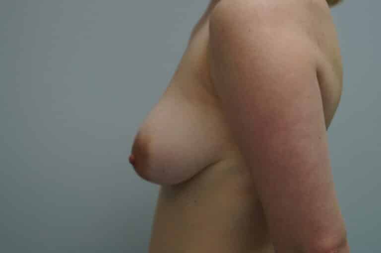 Before Image: Breast Lift with Implants - left-side