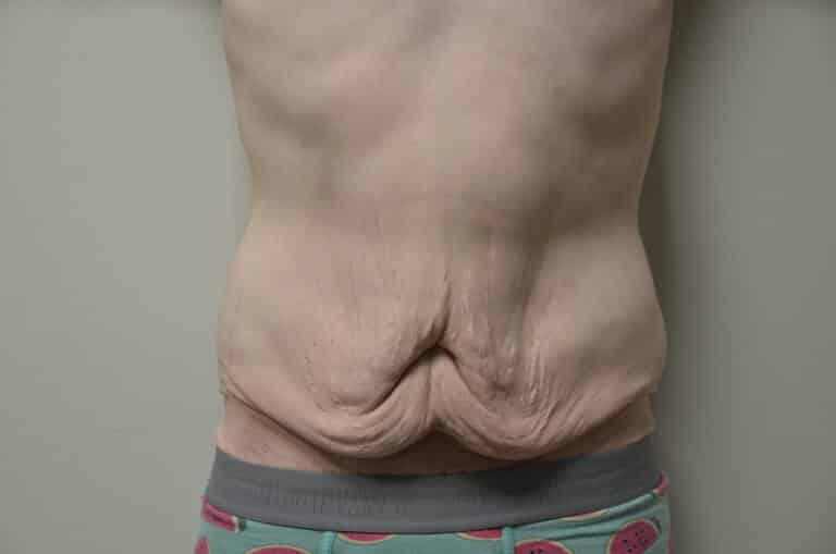 Before Image: Tummy Tuck - front