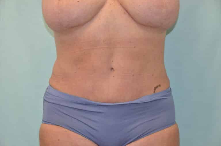 After Image: Tummy Tuck - front