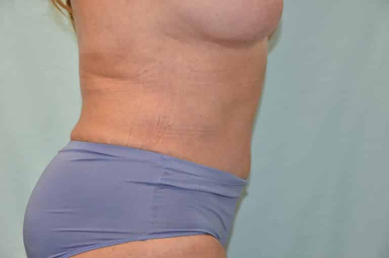 After Image: Tummy Tuck - right-side