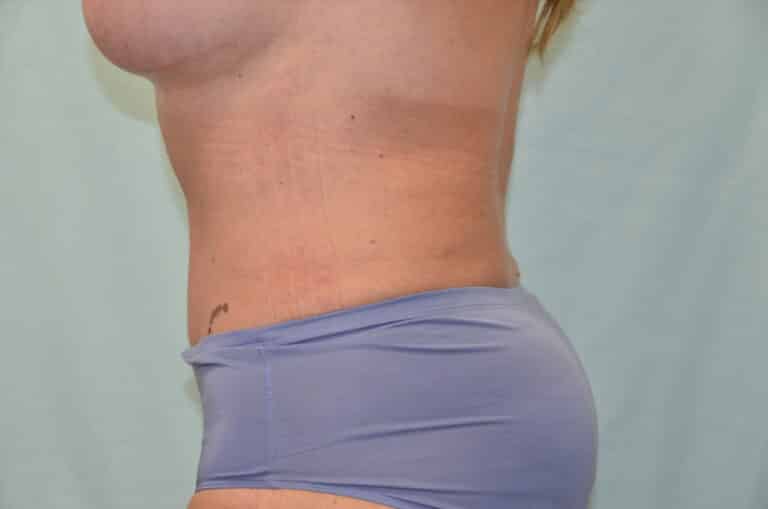 After Image: Tummy Tuck - left-side