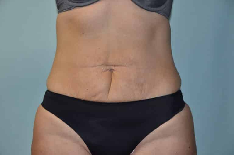 Before Image: Tummy Tuck - front