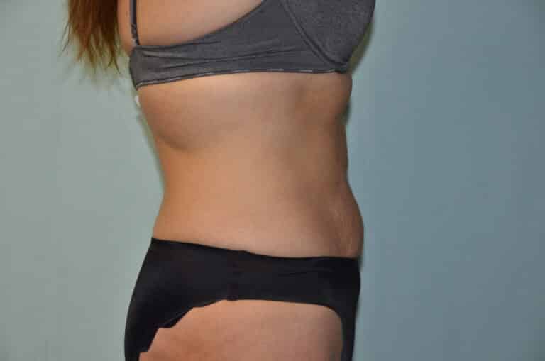 Before Image: Tummy Tuck - right-side