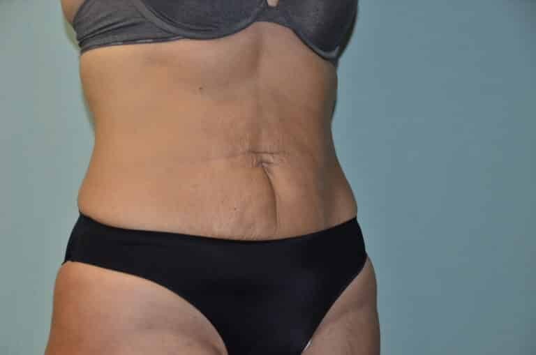 Before Image: Tummy Tuck - right-front-oblique