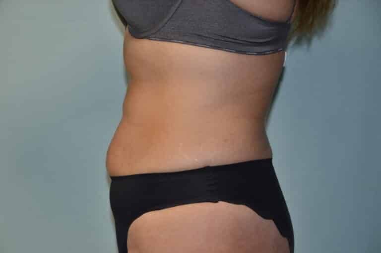 Before Image: Tummy Tuck - left-side