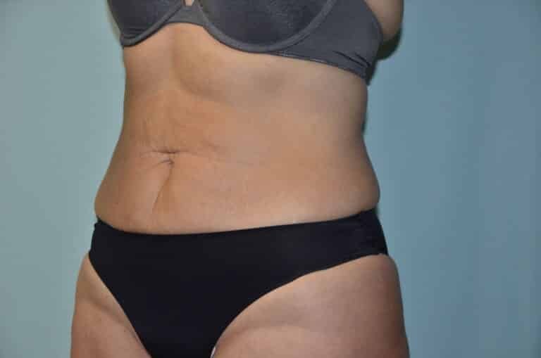 Before Image: Tummy Tuck - left-front-oblique