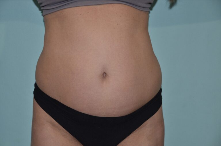 Before Image: Tummy Tuck - front