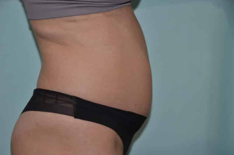 Before Image: Tummy Tuck - right-side