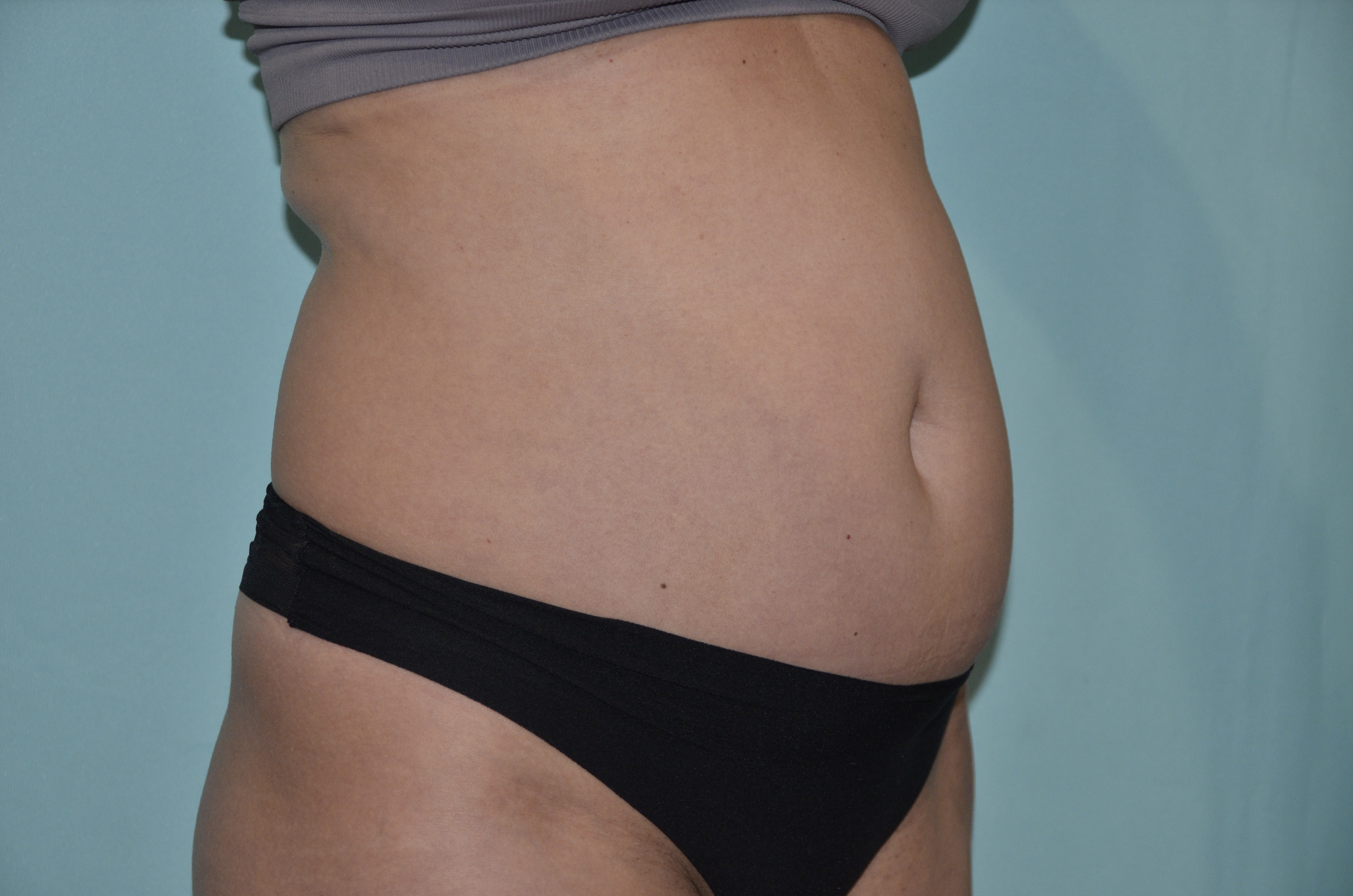 Before Image: Tummy Tuck - right-front-oblique