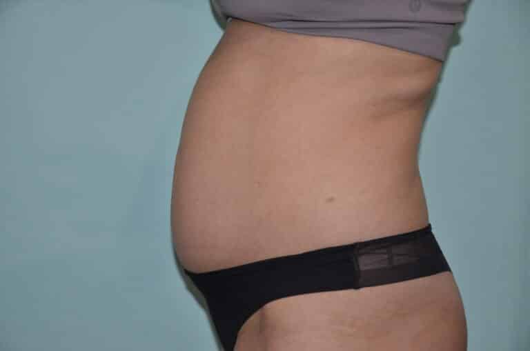 Before Image: Tummy Tuck - left-side