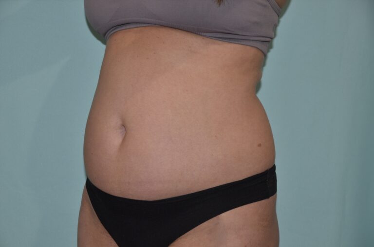 Before Image: Tummy Tuck - left-front-oblique