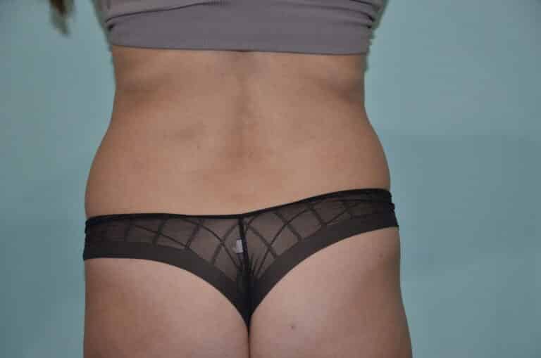 Before Image: Tummy Tuck - back